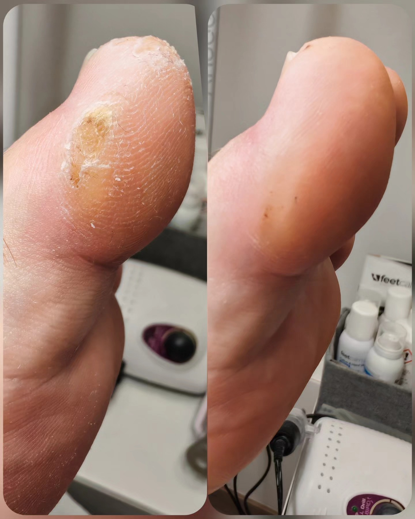 Rezultat pedikure - pred in po