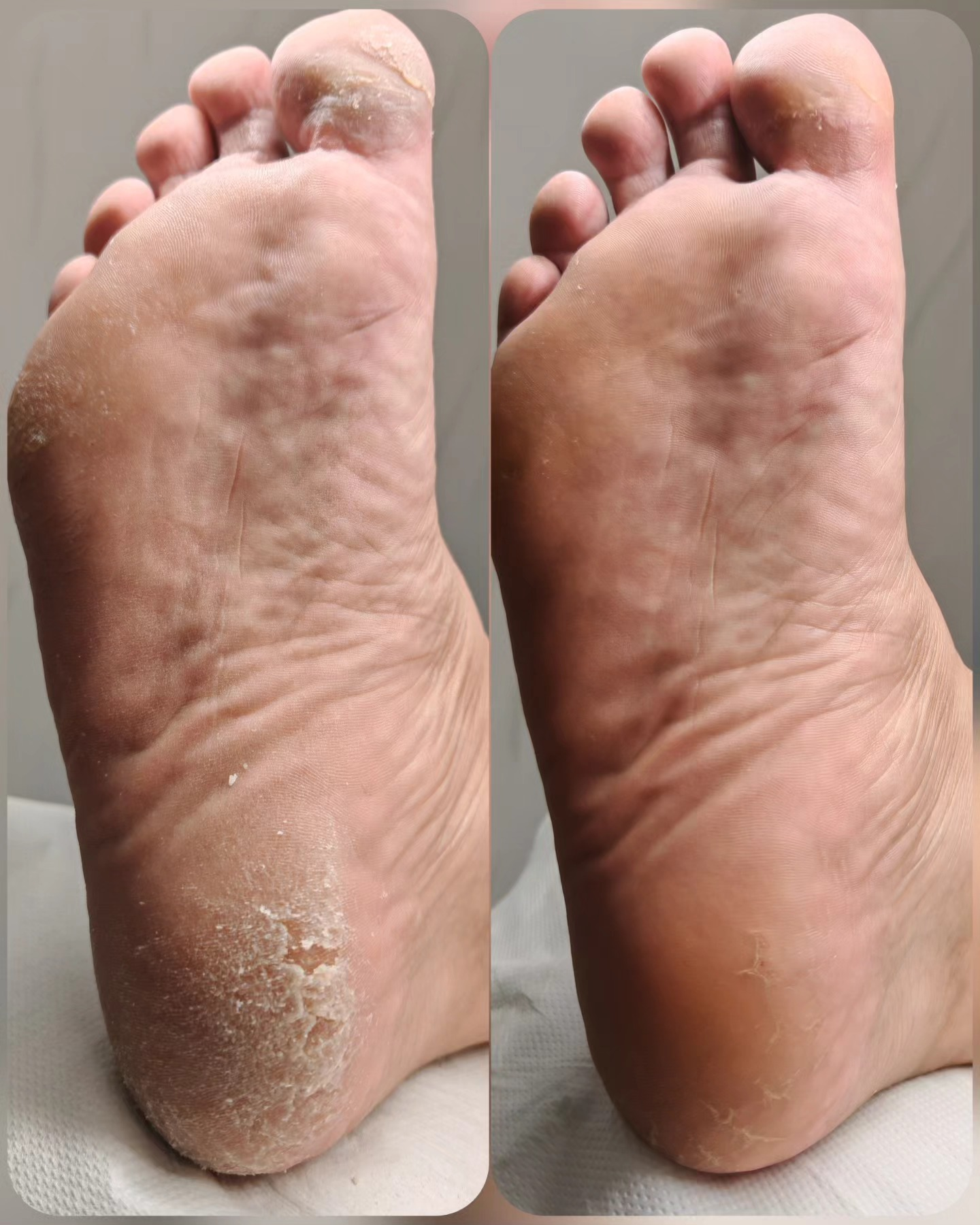 Nega stopal - pred in po